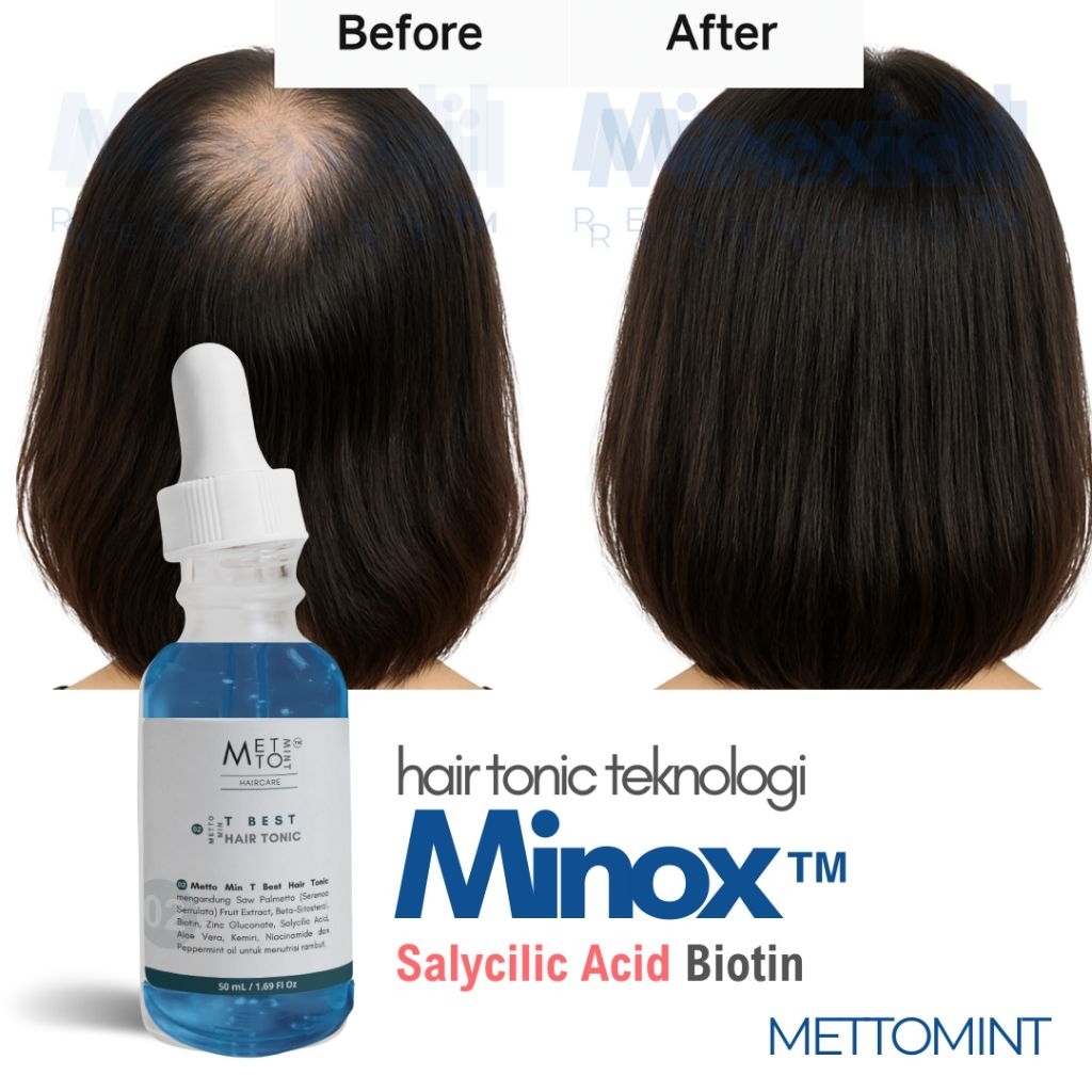Salicylic Acid Minoxidil Reseller Minox Penumbuh Rambut Minoxidil 5% Minoxidil 10% Minoxidil 15% Res