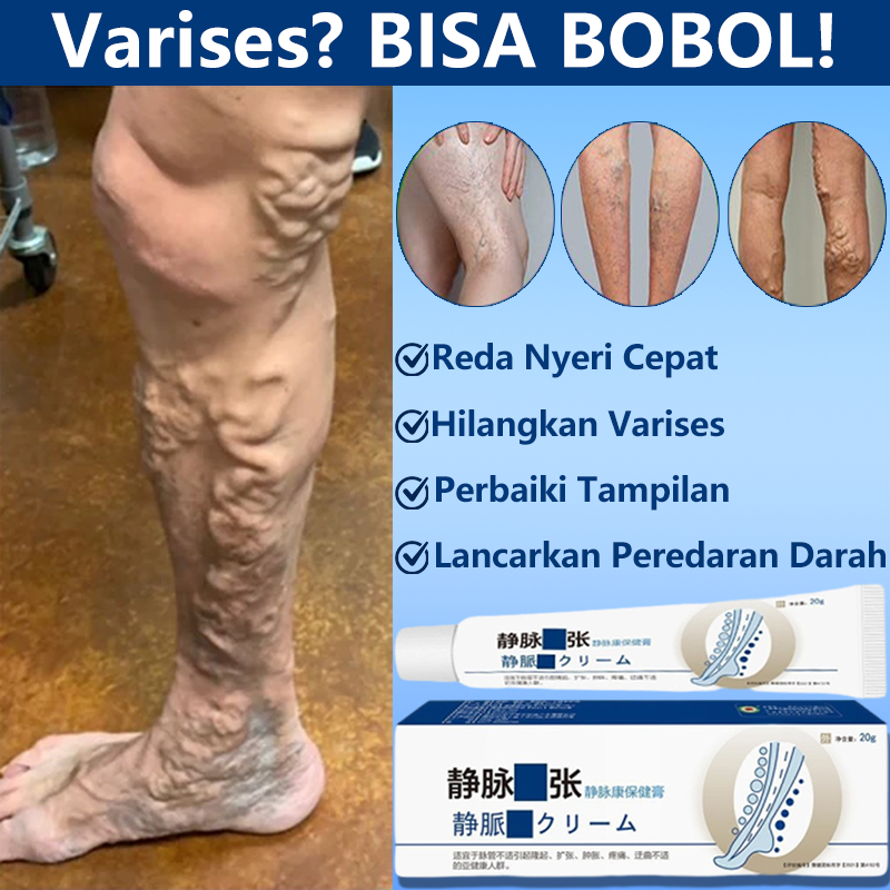 【100% Asli】Obat varises kaki Salep varises paling ampuh Krim kaki 20g Varises cream original Salep s