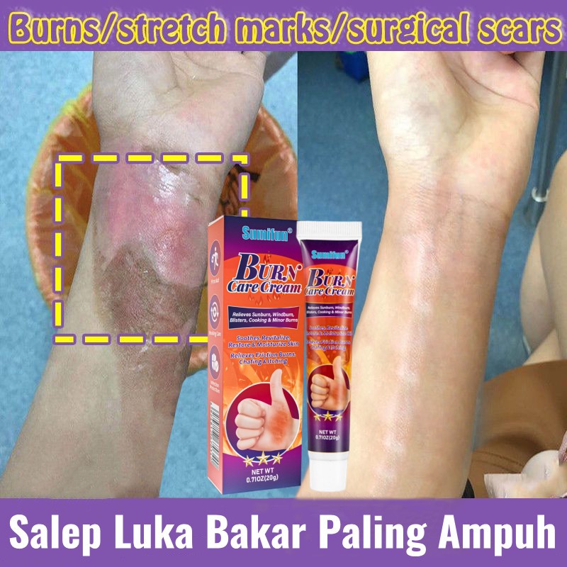 Salep luka bakar Penghilang luka bakar Menghilangkan Bekas Luka Dan Luka Bakar Burns Scalds Antibakt