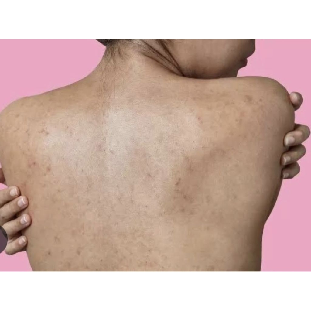 Bedak Kocok Untuk Jerawat Dada dan Punggung