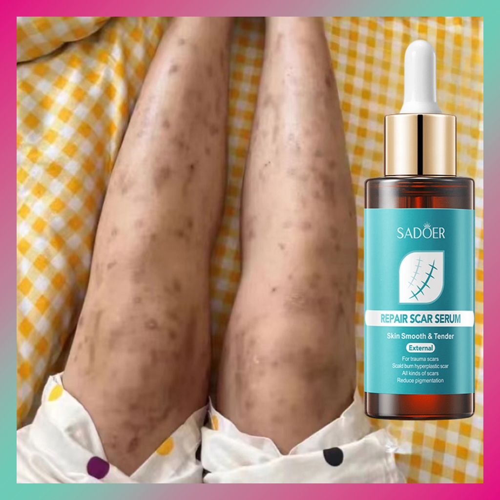 Serum Perbaikan Bekas Luka SADOER 40ml | Serum Perbaikan Bekas Luka | Keloid dan Stretch Mark