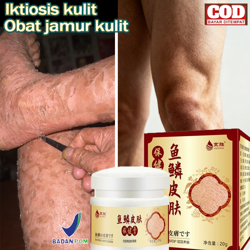 Obat gatal kulit Salep eksim Iktiosis Iktiosis kulit Obat jamur kulit Salep kulit 20gKrim kaki pecah