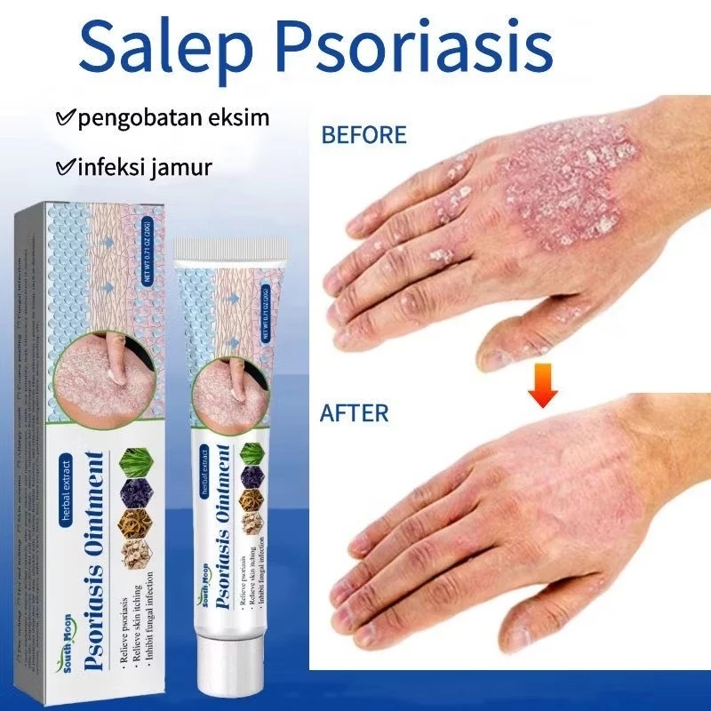 Obat Gatal 20g Obat Gatal Selangkangan Psoriasis Psoriasis Cream Obat Psoriasis Obat Gatal Cerave Ps