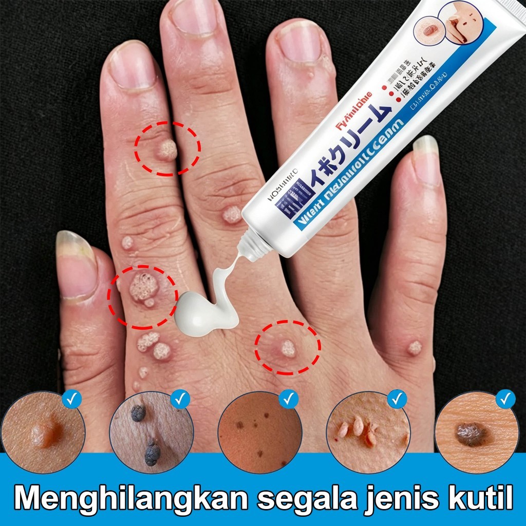 Obat kutil ampuh ori Salep Kutil  Penghilang kutil dan tahi lalat skin tag remover Wart Remover Oint