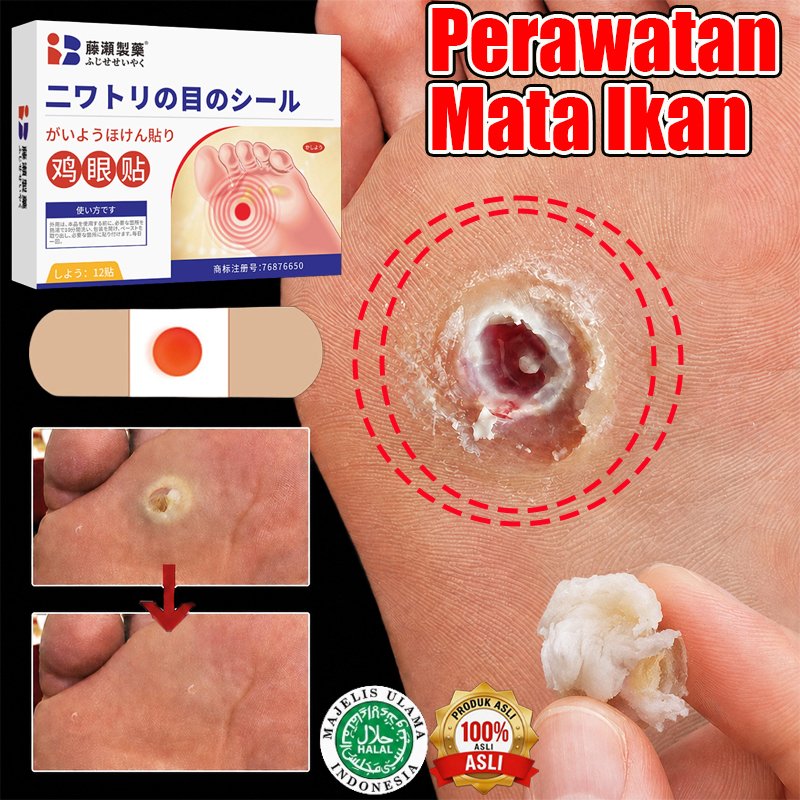 Plester Mata Ikan Corn Patches 0bat Mata Ikan Di Kaki Penghilang Mata Ikan Di Tangan Foot Corn Remov