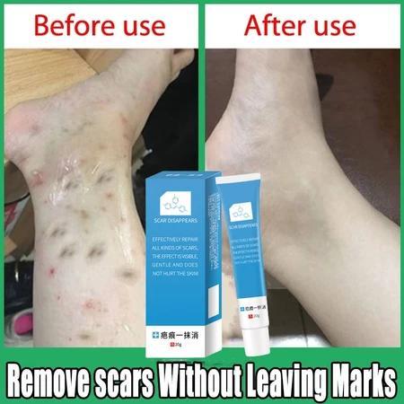 Penawaran besar penghilang bekas luka-Cream Penghilang Bekas Luka-salep penghilang bekas luka-penghi