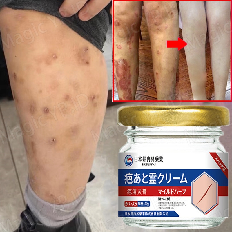 penghilang bekas luka hitam koreng penghilang bekas luka penghilang luka koreng bekas gatal gatal pe