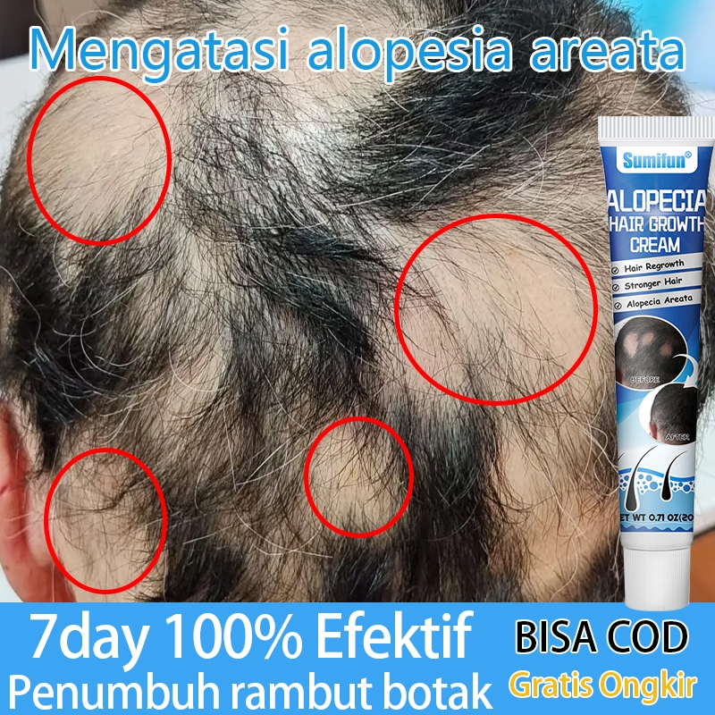 Obat Alopecia Areata, Krim Perawatan Kulit Kepala untuk Mengatasi Alopecia Areata dan Menumbuhkan Ra