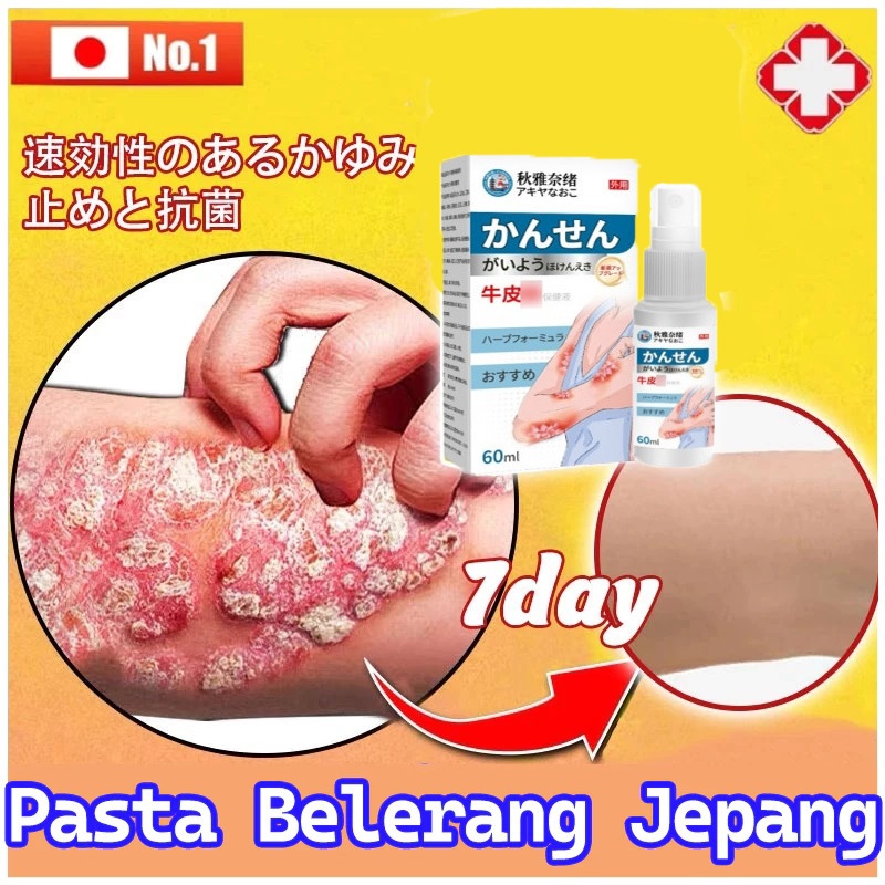 Salep Gatal Paling Ampuh Anti Jamur Gatal Gatal Seluruh Badan Obat Gatal Kulit Salep Eksim Gatal Sal