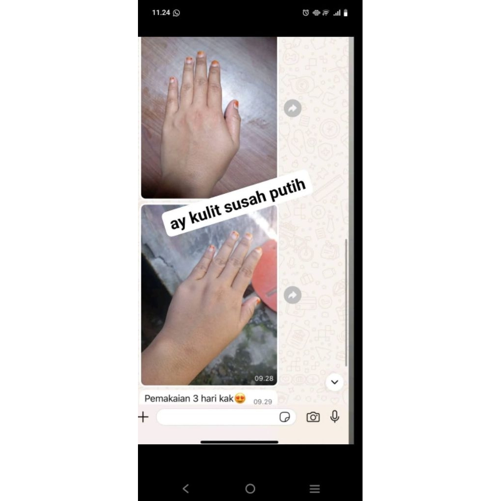 AY Hb kulit susah putih