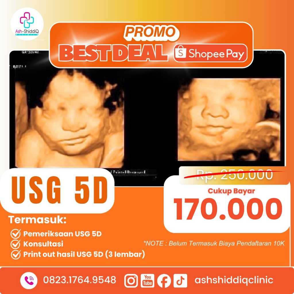 Paket USG 5D Kehamilan - Best Deal, Sudah Termasuk: Print Out hasil USG 5D (1 Lembar), Konsultasi, P