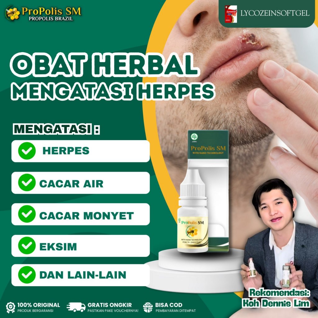Obat Herpes Bibir Herpes Kulit Cacar Eksim Menahun Cacar Monyet Pengering Luka Herpes Propolis SM