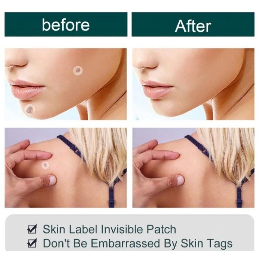 INSTANT SKIN TAG REMOVAL PATCHES Bpom