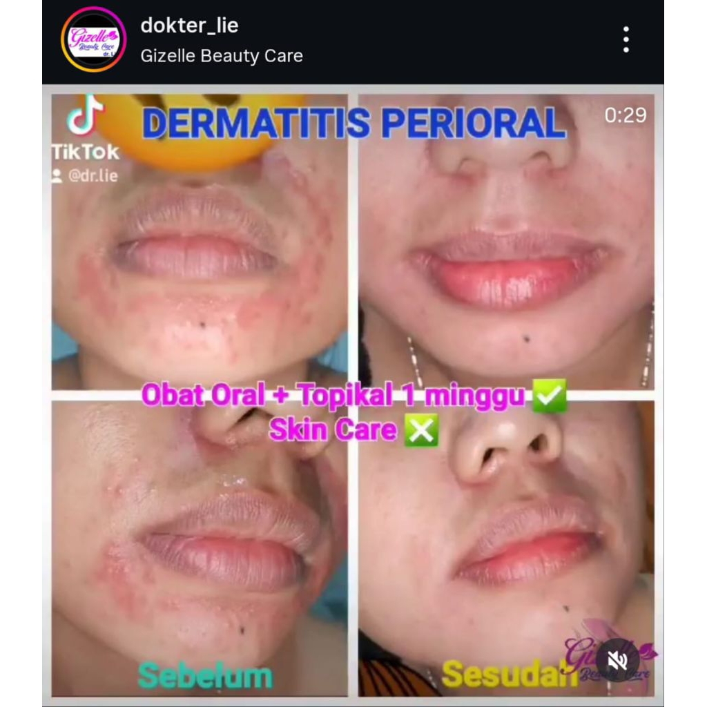 SALEP DERMATITIS & BRUNTUSAN