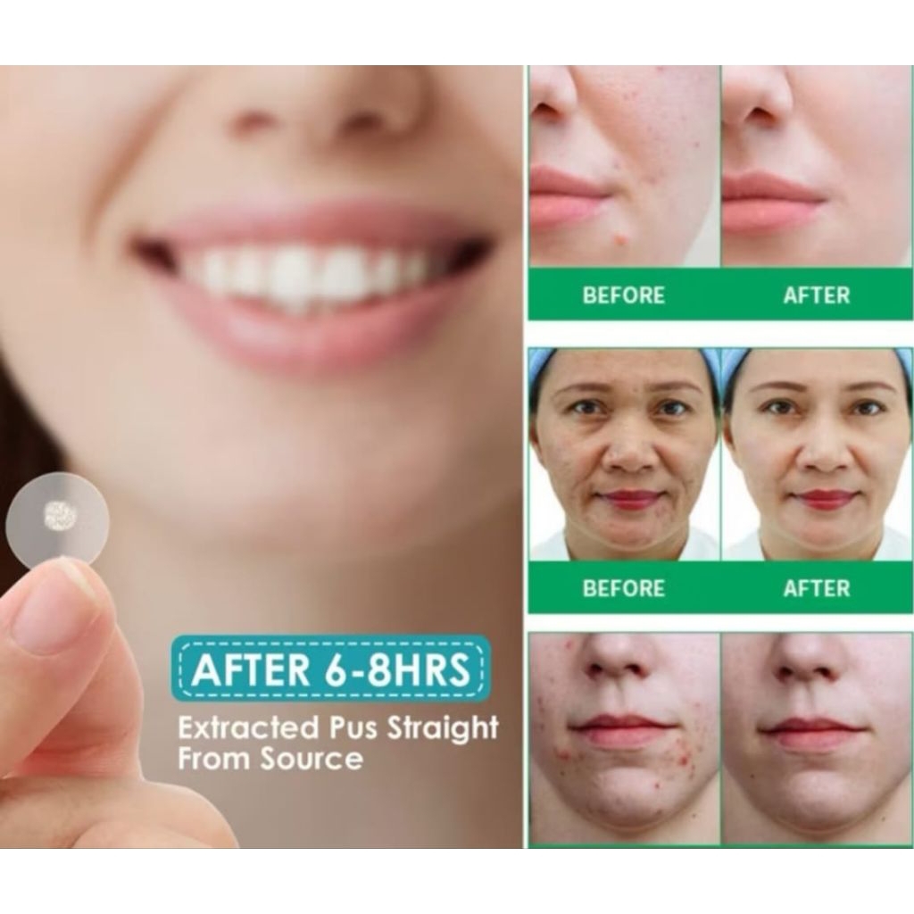 Plester Jerawat Acne Patch 36 pcs