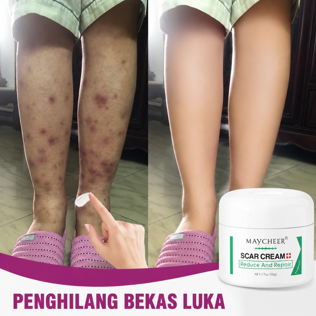 Obat penghilang bekas luka Salep penghilang bekas luka Penghilang bekas luka hitam Menghilangkan bek