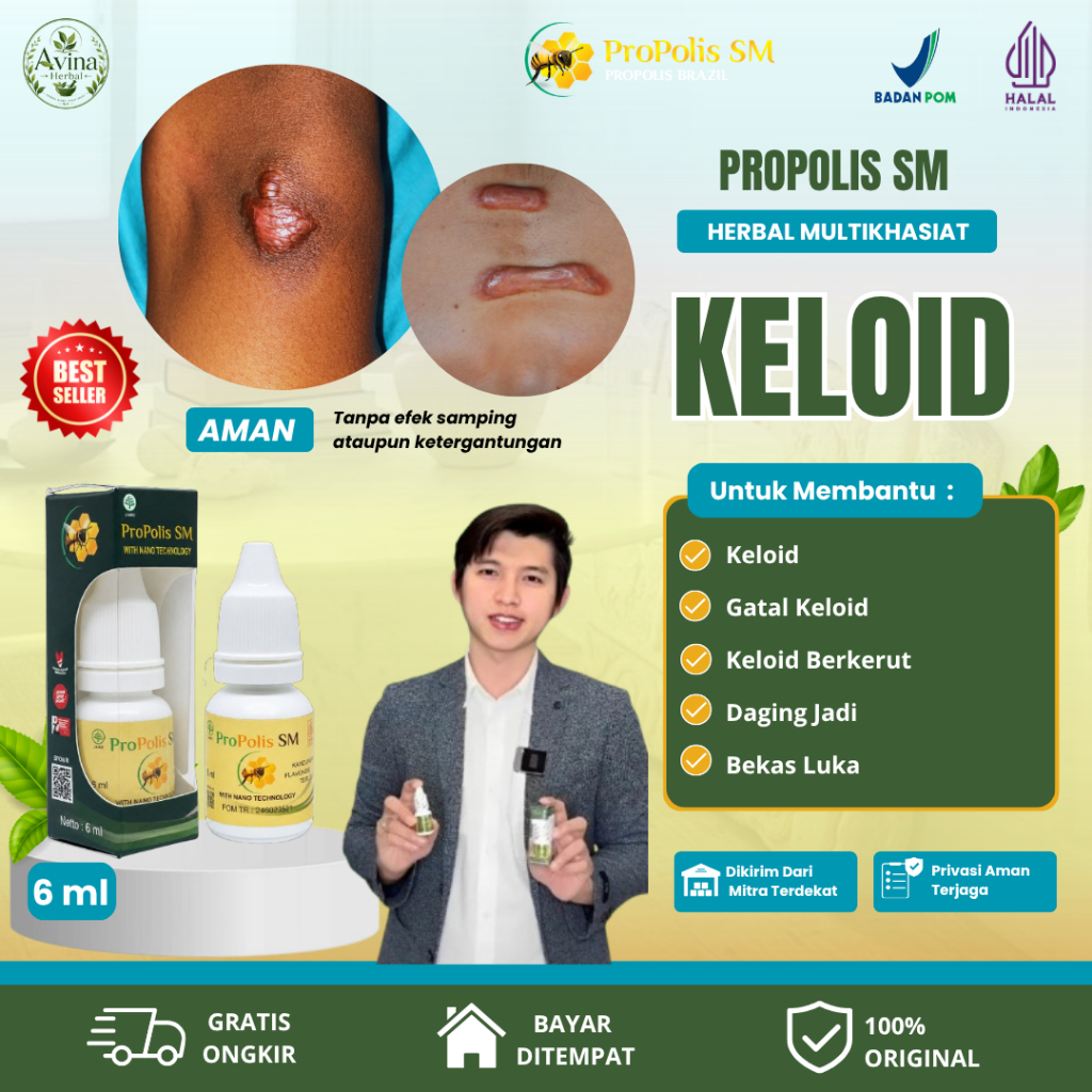 Propolis SM Obat Keloid, Gatal Keloid, Keloid Berkerut, Daging Tumbuh, & Menghilangkan Bekas Luka 10