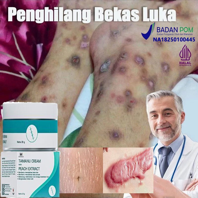 badgePenghilang bekas luka Cream penghilang bekas luka koreng Penghilang bekas luka anak Penghilang 