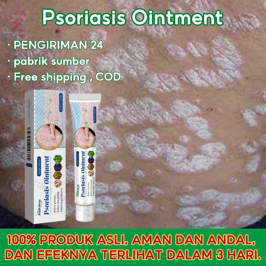 South Moon Obat Gatal 20g Obat Gatal Selangkangan Psoriasis Psoriasis Cream Obat Psoriasis Obat Gata
