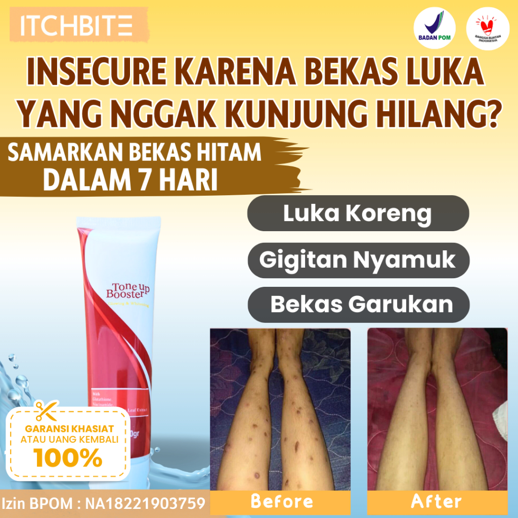 Penghilang Bekas Luka Koreng Cacar Obat Bekas Luka Menahun Pencerah Kulit Belang