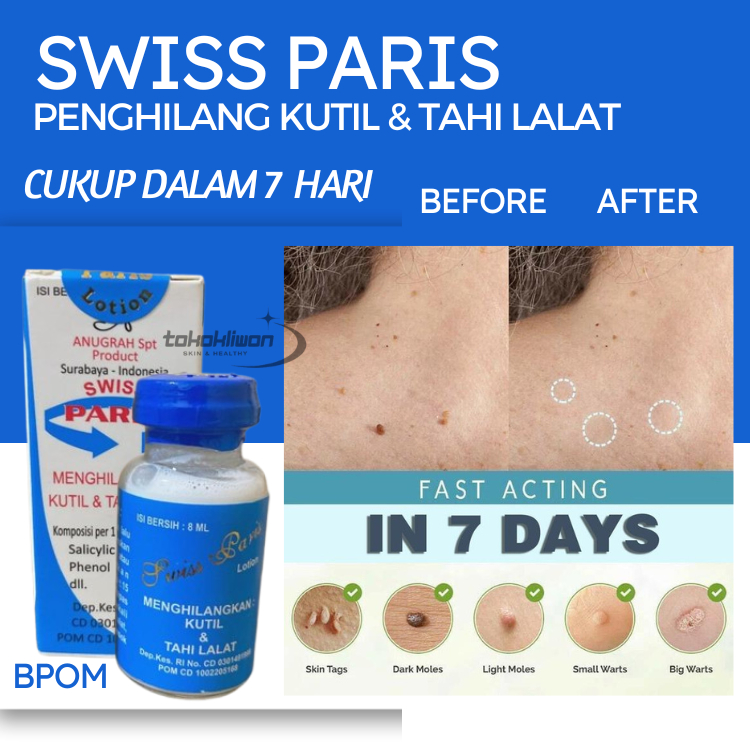 Swiss Paris Lotion Penghilang Tahi Lalat & Obat Kutil Paling Ampuh tanpa operasi
