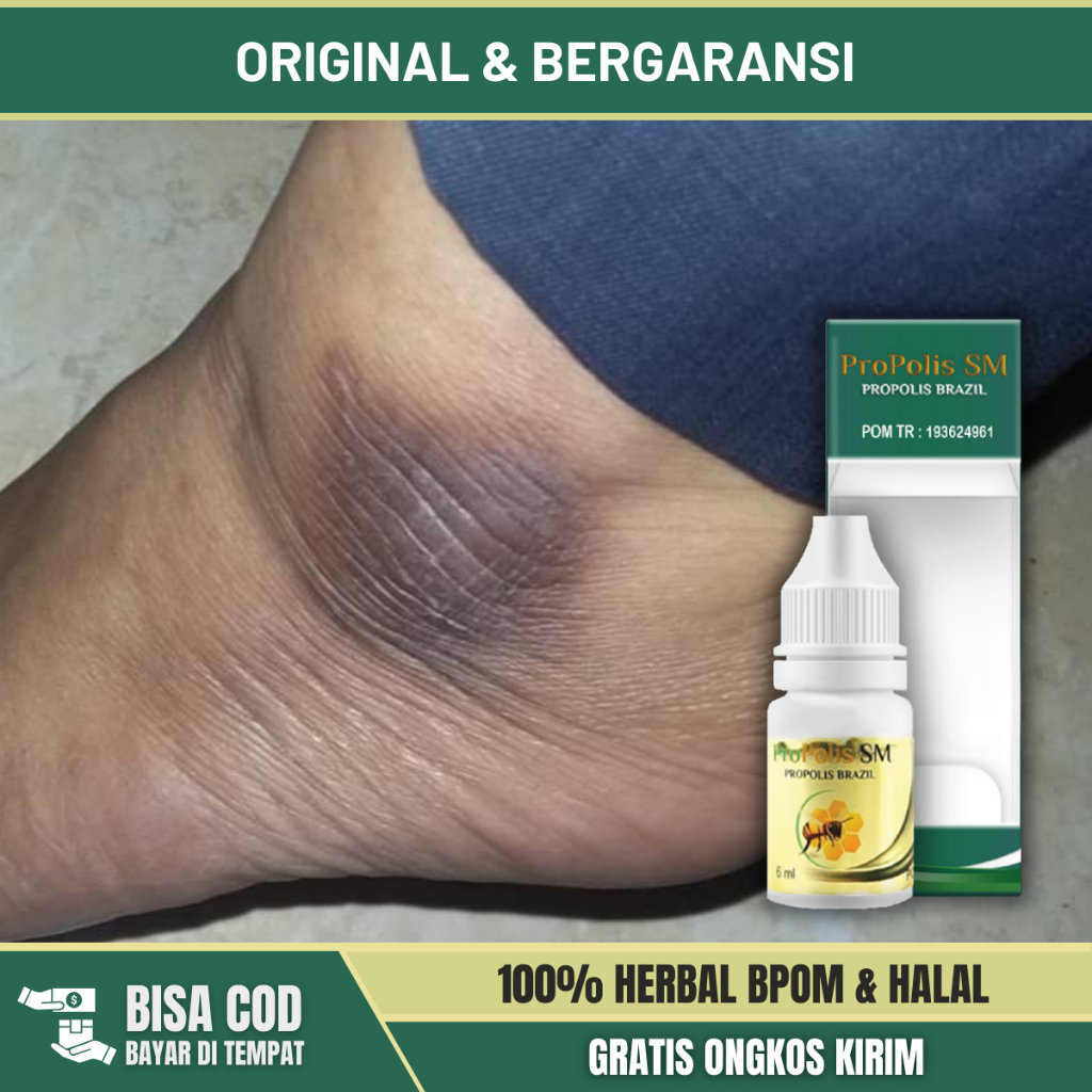 Obat Mata Kaki Hitam, Obat Penghilang Hitam di Mata Kaki, Obat Mata Kaki Kapalan, Obat Kulit Mata Ka