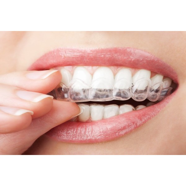 CLEAR RETAINER / RETAINER GIGI / PENCEGAH GIGI BERANTAKAN