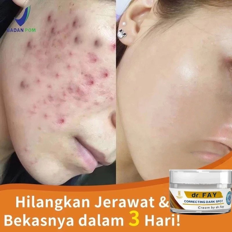 Dr.Fay Penghilang Bekas Jerawat Bopeng Cream dr FAY Menghilangkan Flek Hitam di Wajah Dark Spot Orig