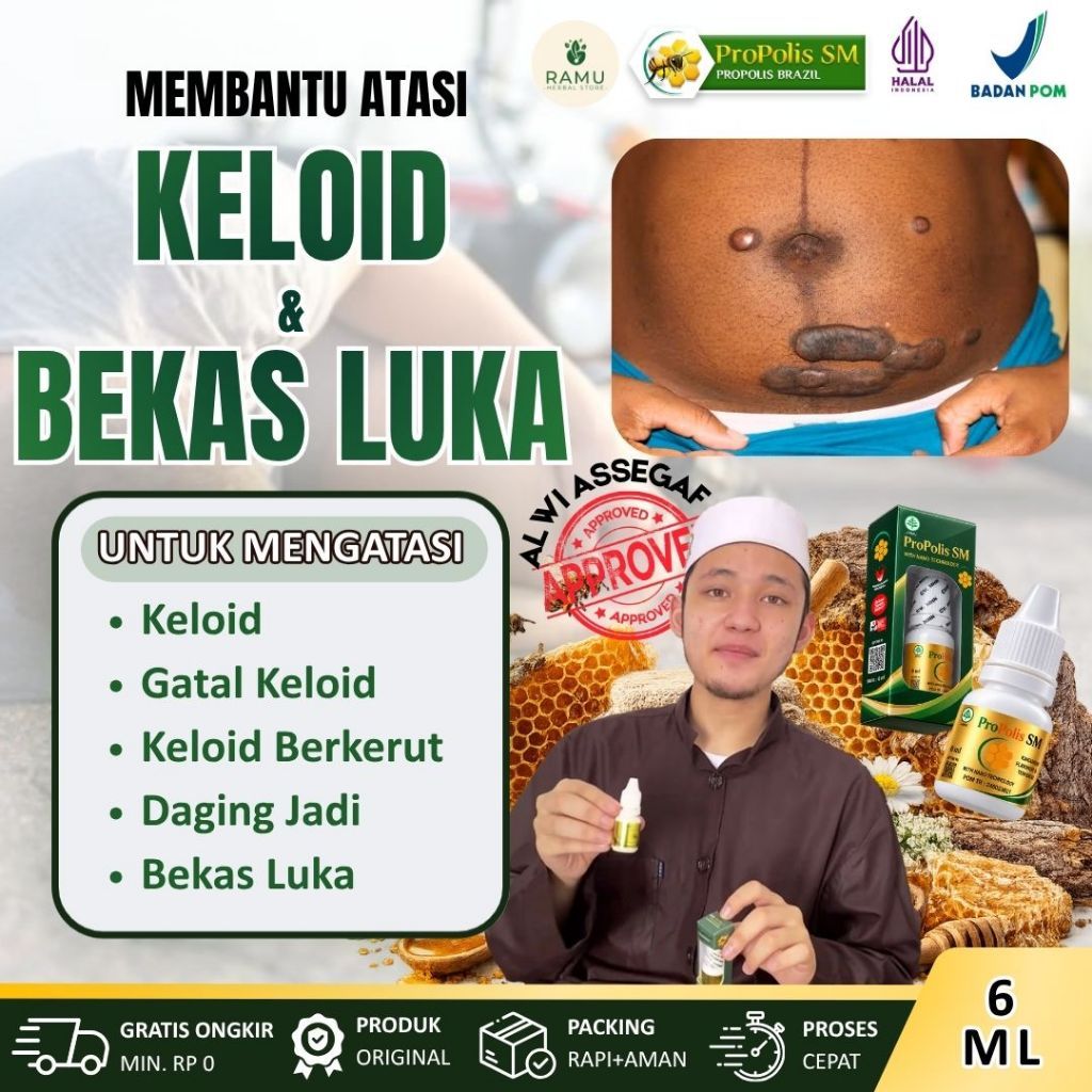 Propolis SM - Obat Penghilang Keloid, Gatal Keloid, Keloid Berkerut, Daging Jadi & Bekas Luka 100% O