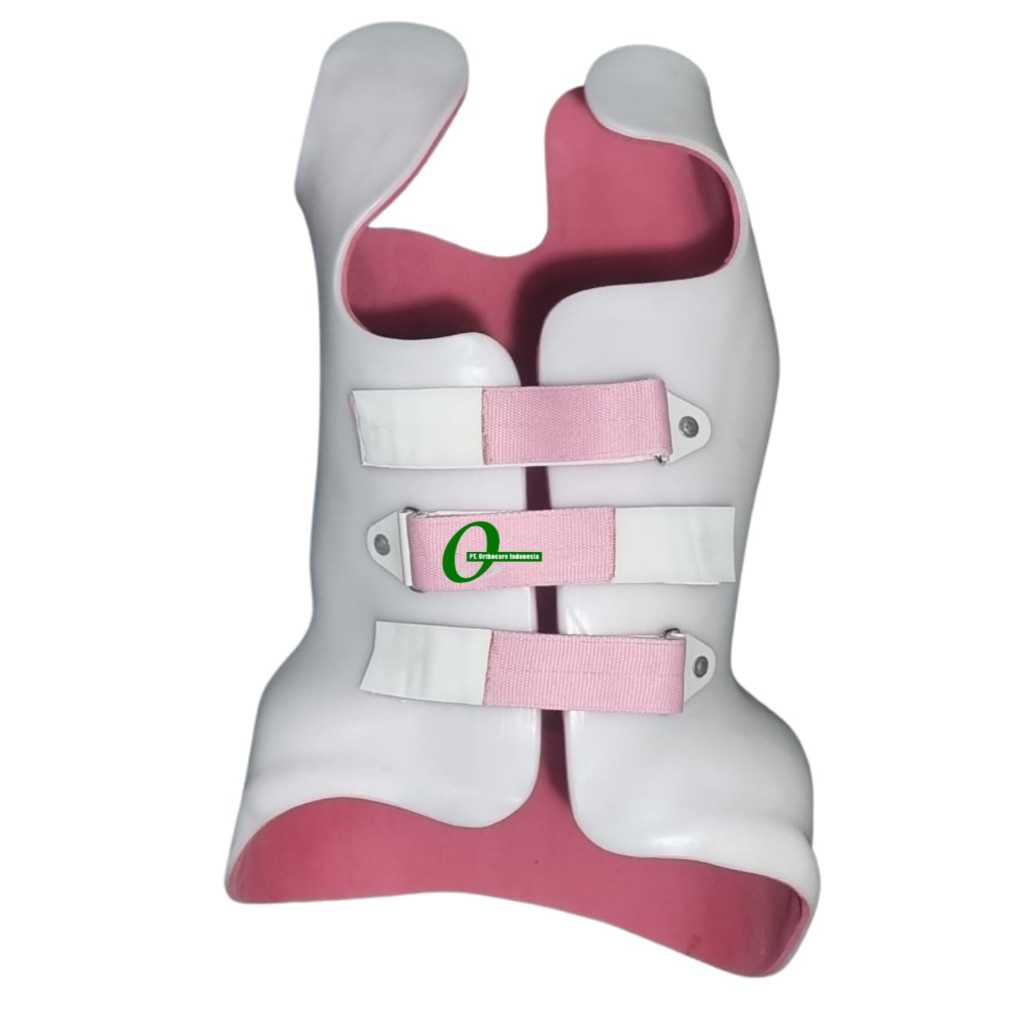 Scoliosis Brace Custom Untuk Penderita Scoliosis