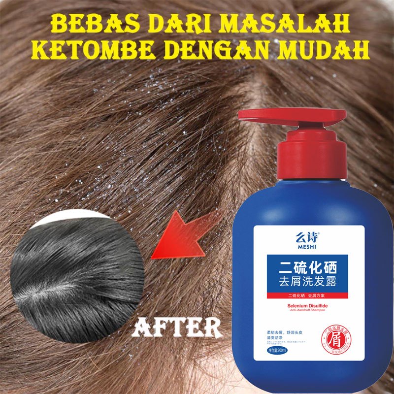 Selenium Disulfide Anti Dandruff Shampoo 300ml Anti Gatal Pengobatan Ketombeshampoo Penghilang Ketom