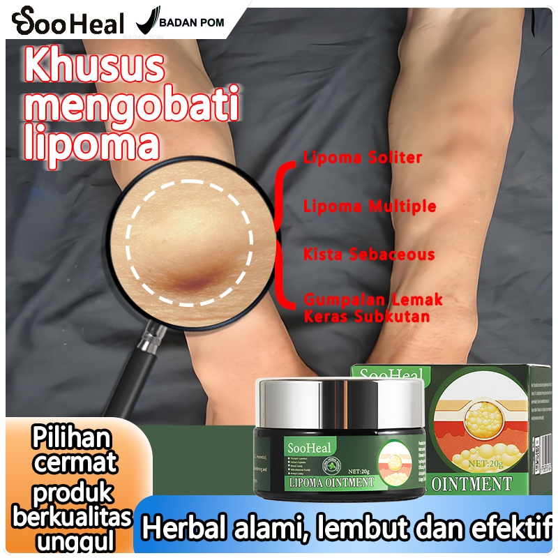 Salep Lipoma Cream Salep Benjolan - Lipoma Cream Original Terfavorit, Lipoma Cream Salep Benjolan Ha