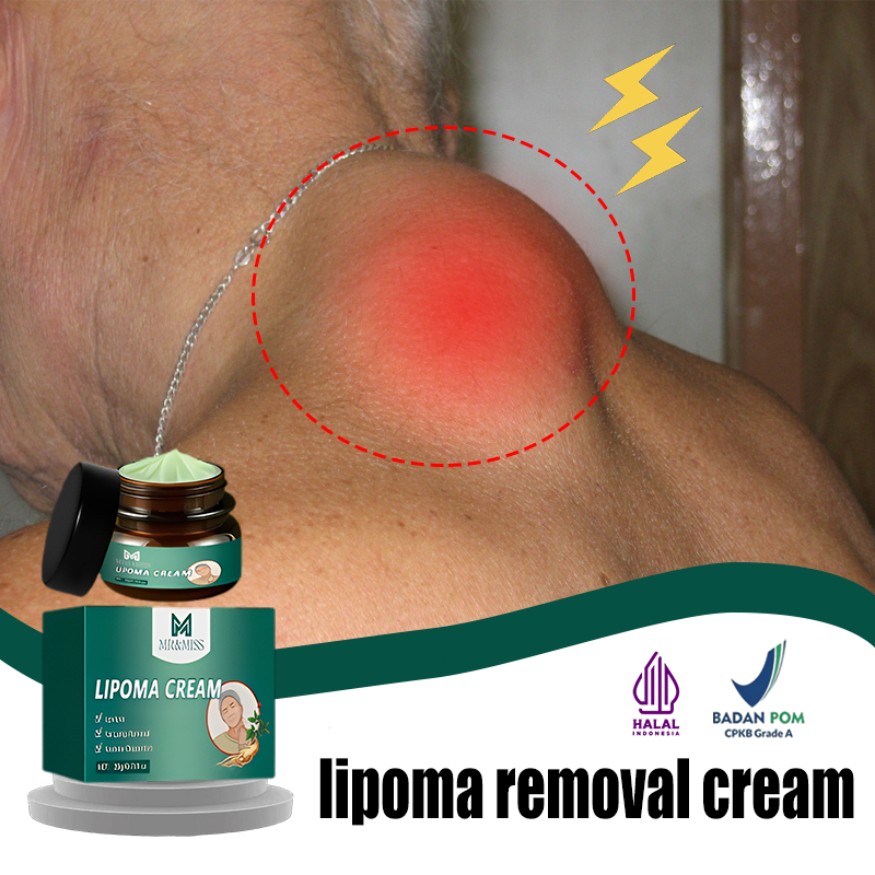 MR&MISS Obat benjolan lipoma removal cream original lipoma removal cream 20ml Salep benjolan ampuh O