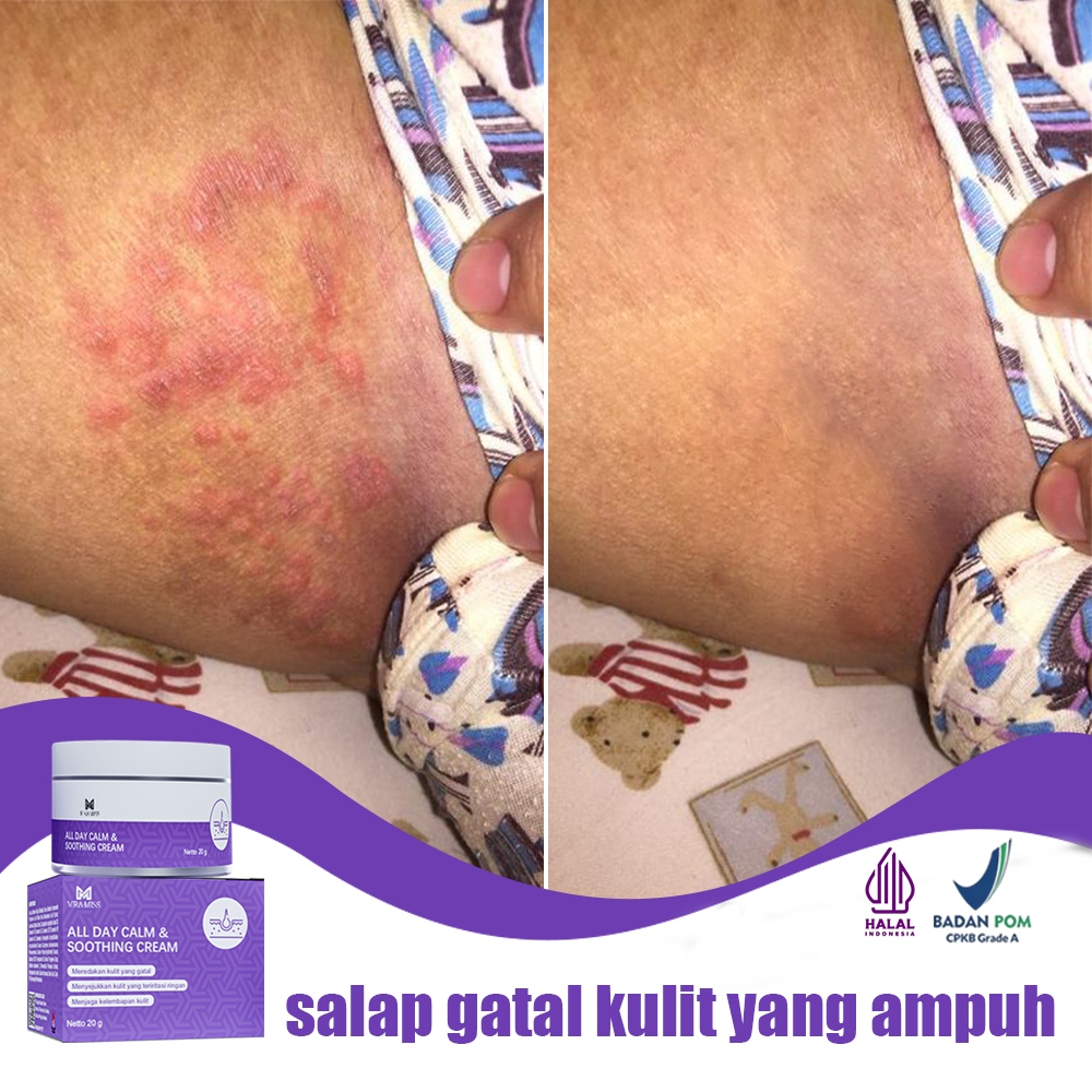 Salep eksim kering dan gatal salap gatal kulit yang ampuh salep china gatal paling ampuh 20g obt sel