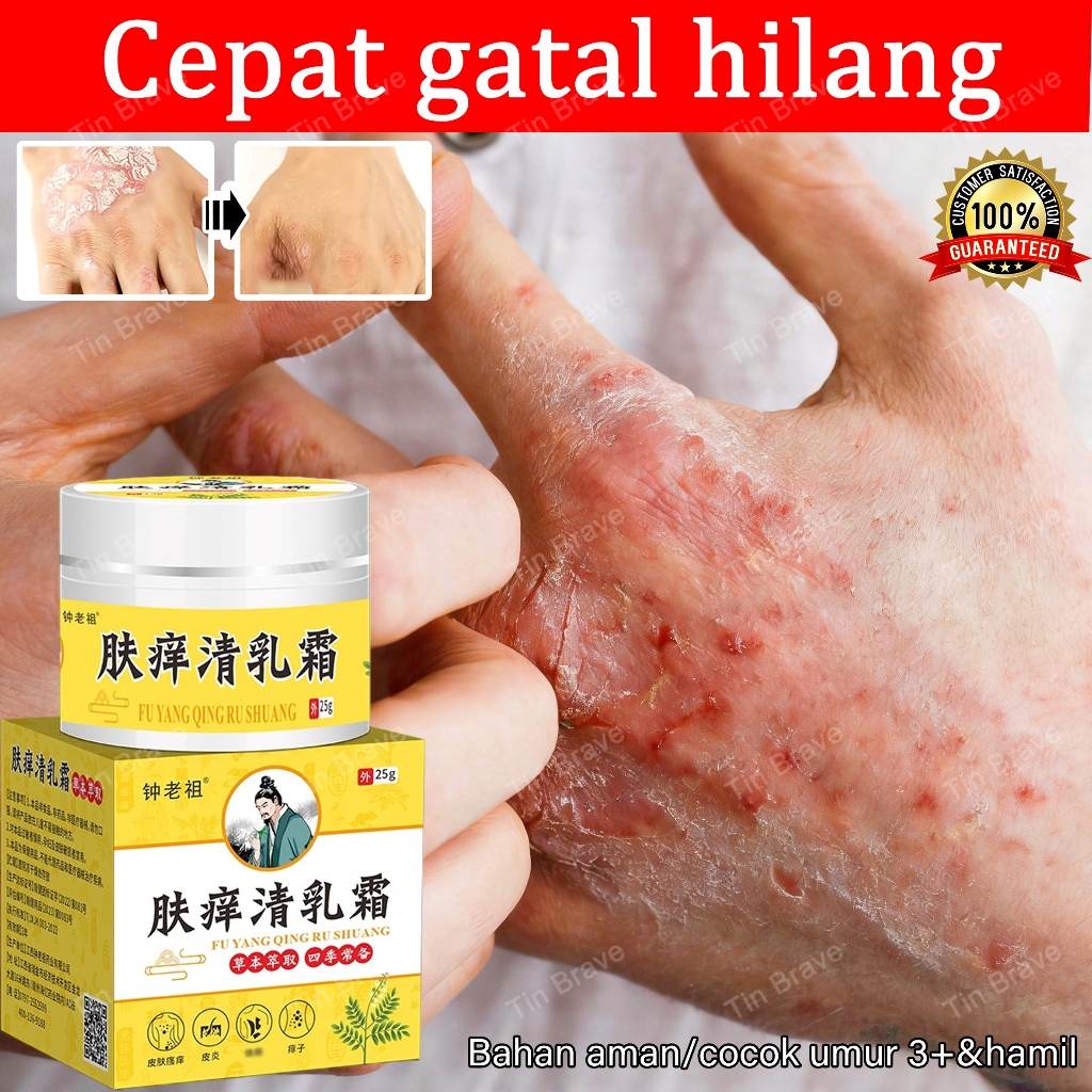 salep eksim kering dan gatal salep gatal china obat gatal selangkangan salep selangkangan eksim dan 