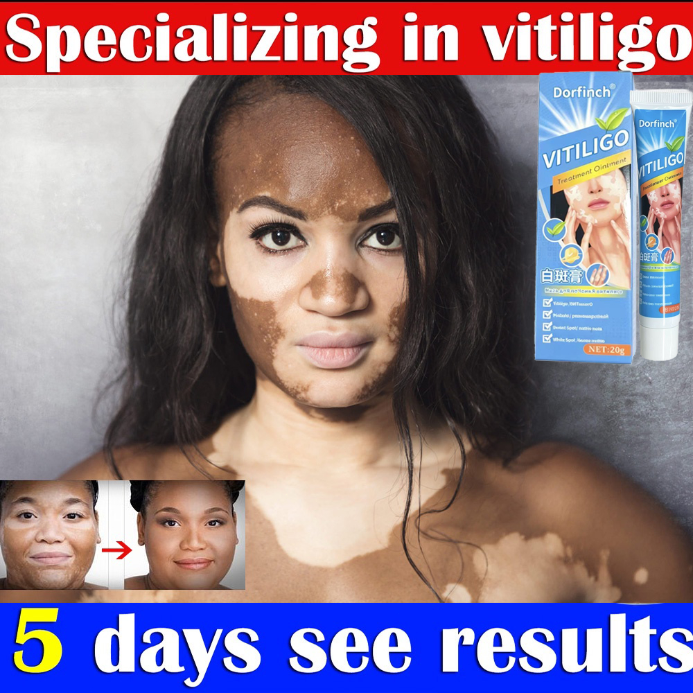 Pengobatan Vitiligo obat vitiligo ampuh /protopic Vitiligo alep vitiligo, panu, biangkeringat, salep