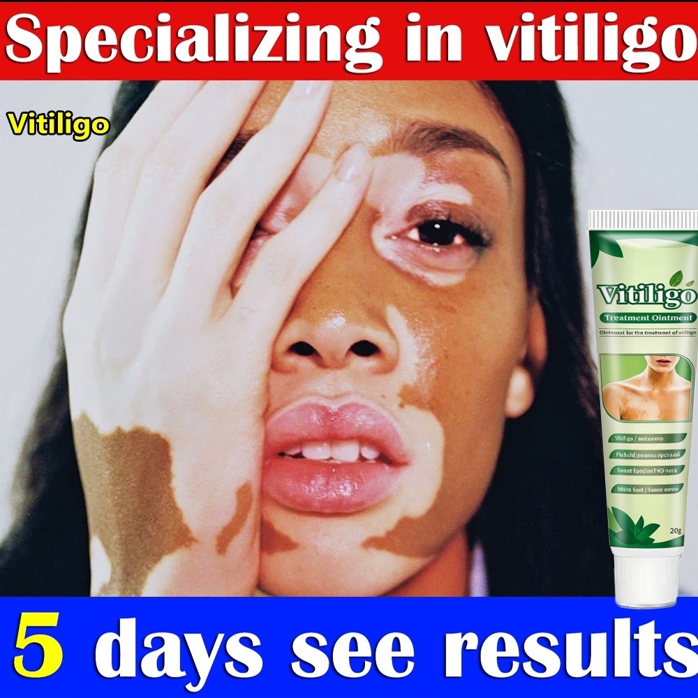 Pengobatan Vitiligo obat vitiligo ampuh /protopic Vitiligo alep vitiligo, panu, biang keringat, sale