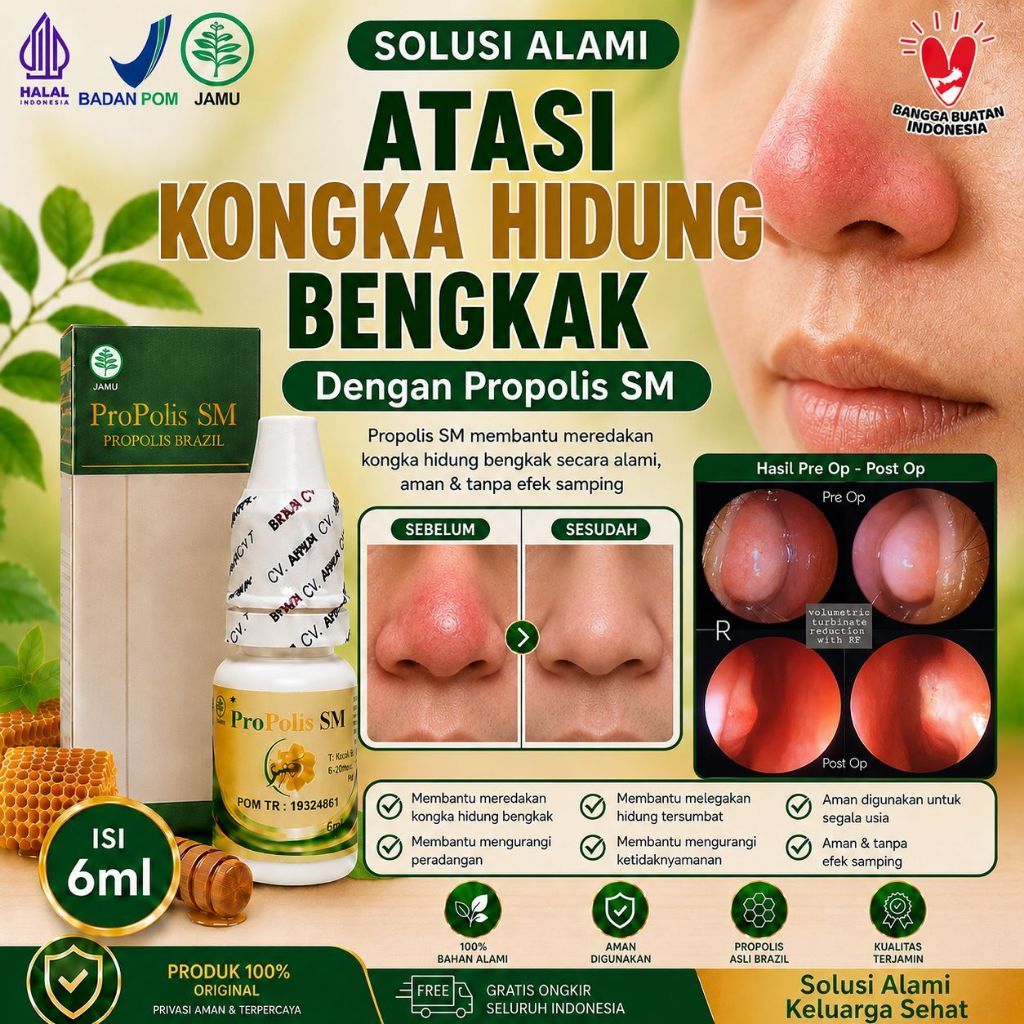 Obat Konka Hidung Bengkak Dan Membesar, Obat Hidung Tersumbat, Obat Benjolan Rongga Hidung, Obat Kon