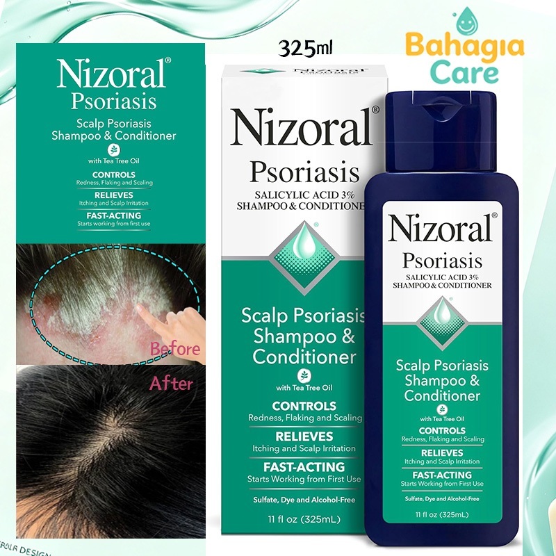 Nizoral Shampoo Psoriasis Kulit Kepala 325ml
