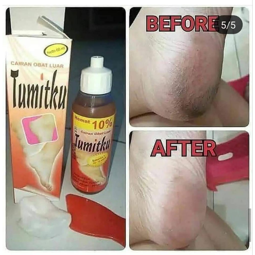 TUMITKU KAKI PECAH PECAH