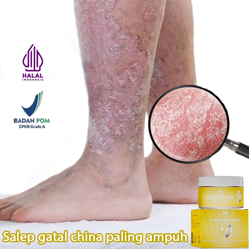 Salap gatal kulit yang ampuh salep gatal selangkangan salep eksim kering dan gatal 20g 0bat gatal ga