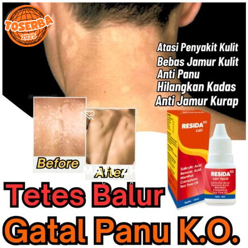 Resida Cair Obat Panu Original Obat Panu Paling Ampuh 100% Cair Original Aman BPOM