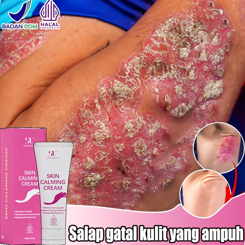 Salap gatal kulit yang ampuh Salep china untuk gatal gatal Obat gatal selangkangan dan hitam 20g oba