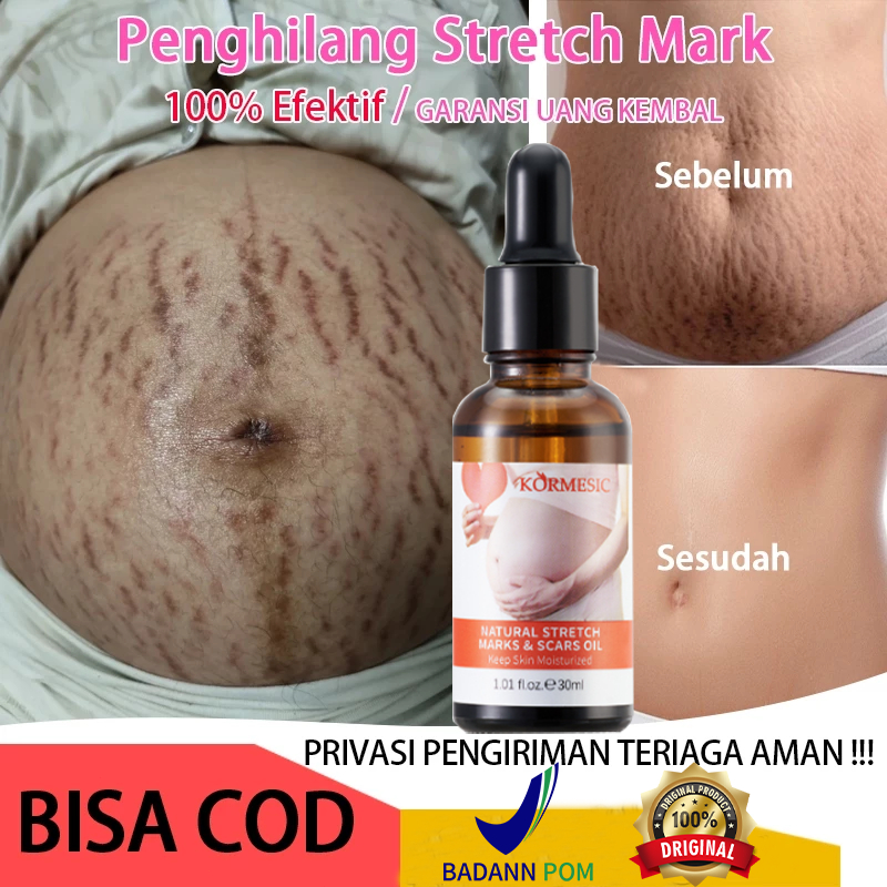 strechmark cream Stretch mark penghilang bekas luka 30ML Minyak esensial penghilang stretch mark Pen