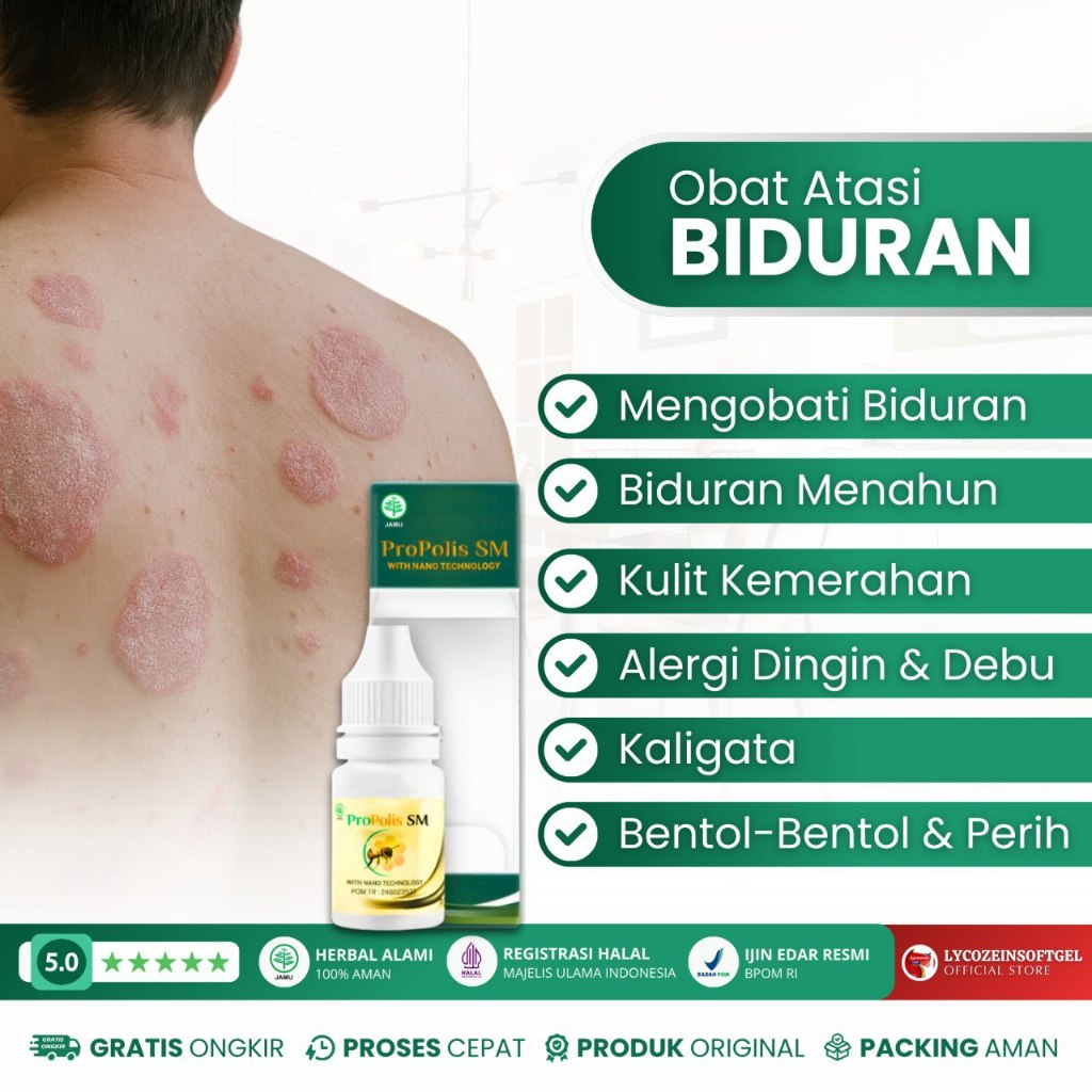 Obat Biduran Gatal Biduran Menahun Kaligata Bentol Bentol Ruam Alergi Kulit Bintik Merah