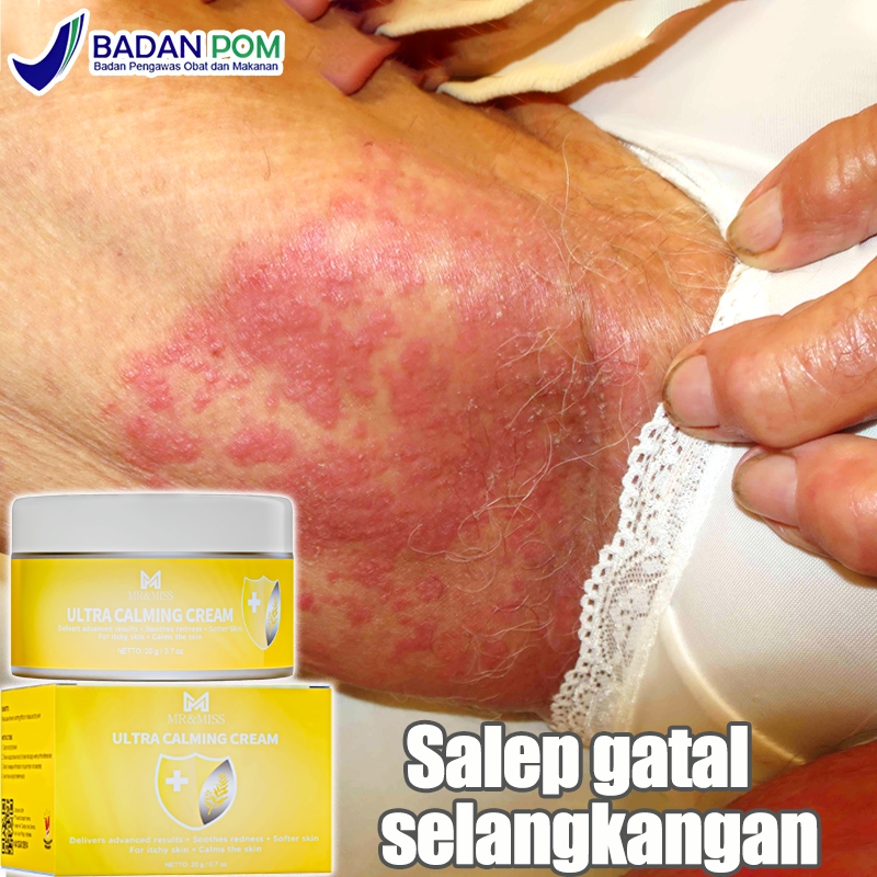 Salep gatal selangkangan Salep gatel 0bat gatal gatal kulit ampuh 20g MR&MISS obat gatal kulit salep