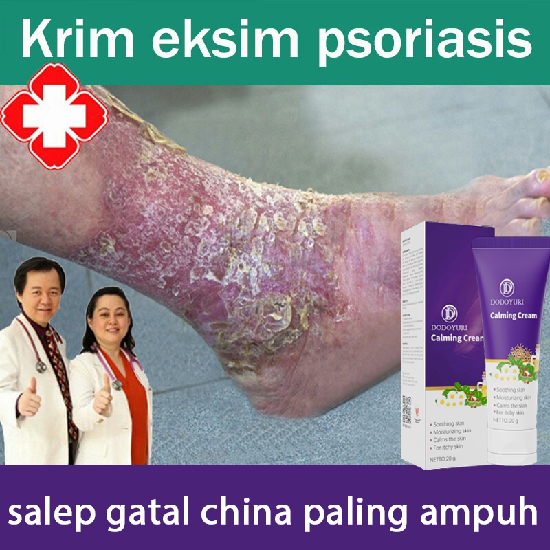 Salap gatal china salap gatal kulit yang ampuh salep china gatal paling ampuh 20g obt selangkangan h
