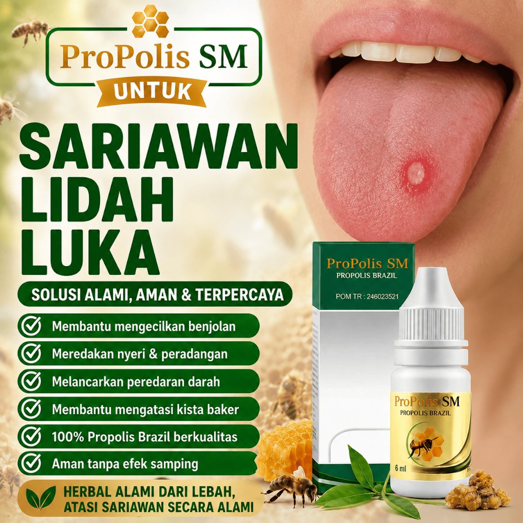 Obat Sariawan Lidah , Sariawan Lidah Luka , Sariawan Anak Dan Dewasa , ProPolis SM 100% ASLI