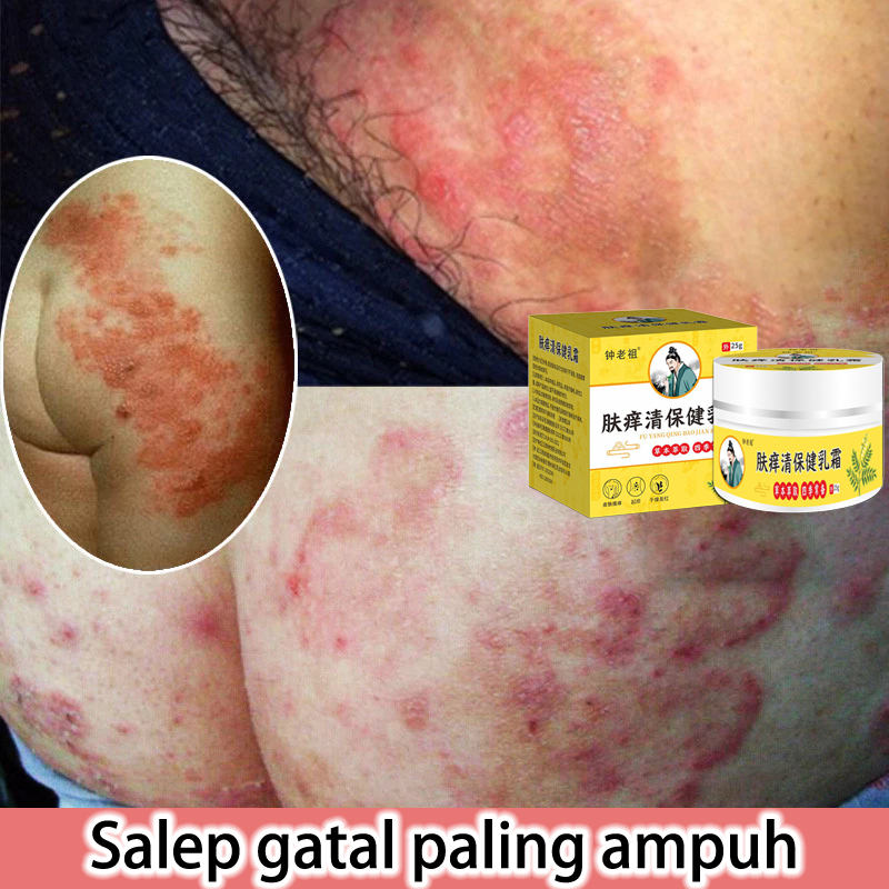 Salep gatal china salep gatal jamur selangkanga Krim Eksim Bayi dan Anak Obat gatal selangkangan sal
