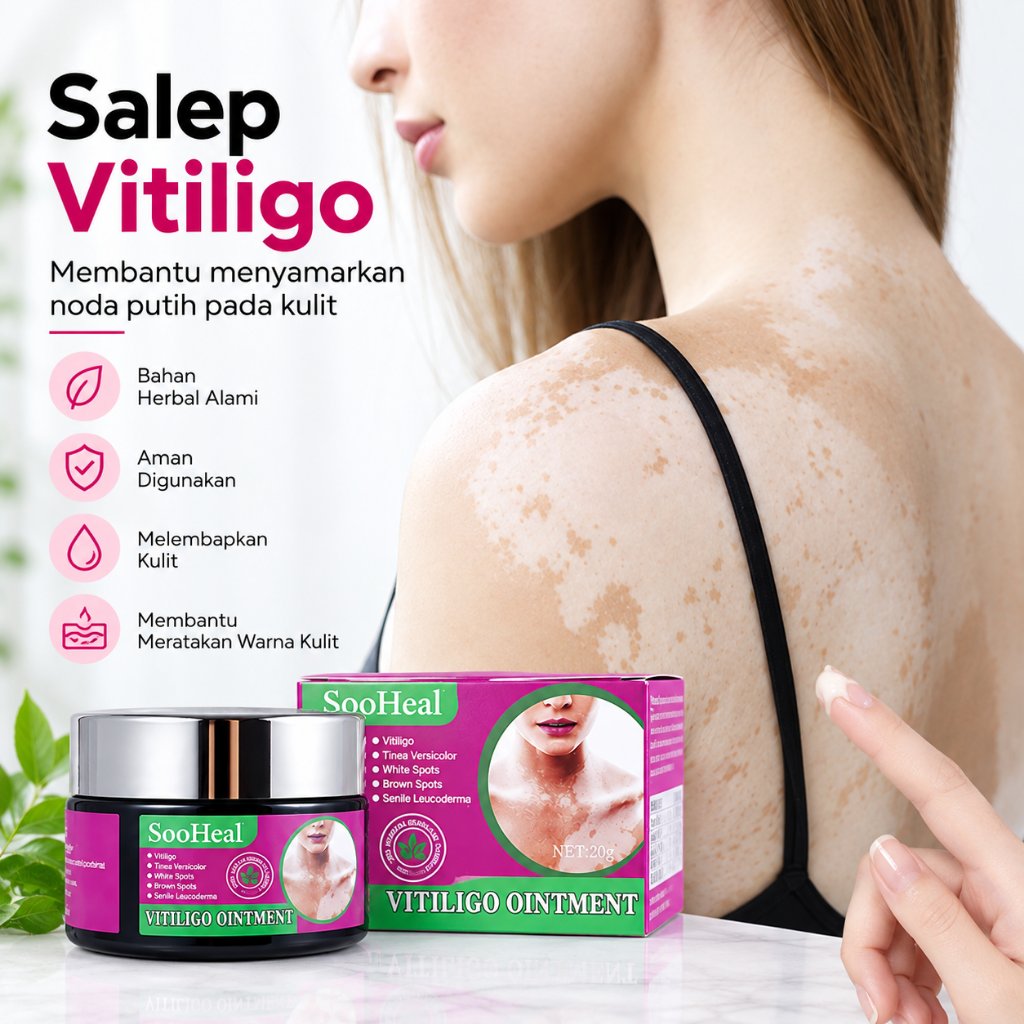 Vitiligo Ointment, Salep Vitiligo, Salep Putih Kulit, 20g, Mengatasi Bercak Putih Di Kulit, Menjaga 